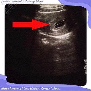 hasil-usg-pertama-kali [annafisfamilyblog]